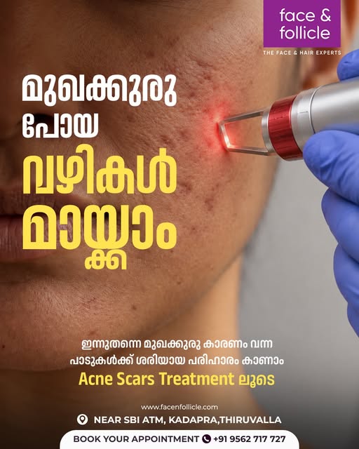 മുഖക്കുരു പോയാലും മായാതെ നിൽക്കുന്ന പാടുകൾ ആണോ നിങ്ങളെയും അലട്ടുന്നത്?
ഇനി വിഷമിക്കേണ്ട! 
Acne Scars