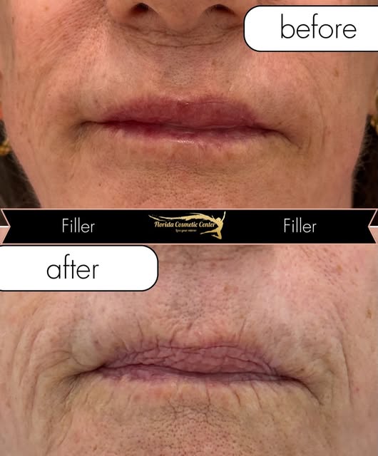 Filler isn’t just about adding volume to the lips. 💋

Strategically placed filler can also help sof