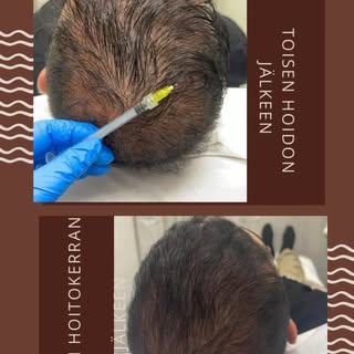 Ongelmana hiusten lähtö? #hairmesoteraphy #hiusmesoterapia #hiustenlähtö #hiuspohjanhoitosarjat #hiu