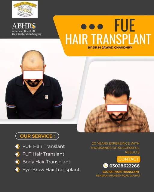 ✨ FROM HAIR LOSS TO HAIR CONFIDENCE! ✨

See how a professionally planned FUE Hair Transplant can tra