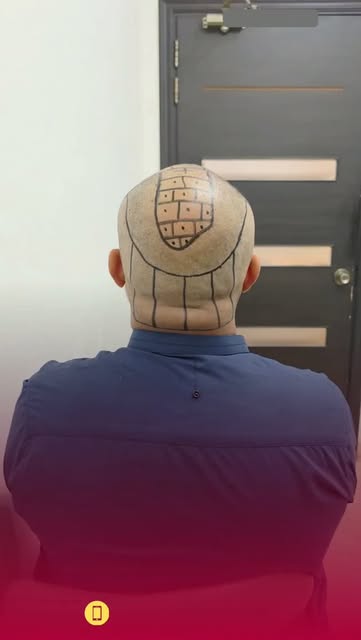 A Successful Hair Transplant Starts with Proper Planning
A great FUE hair transplant is not simply a