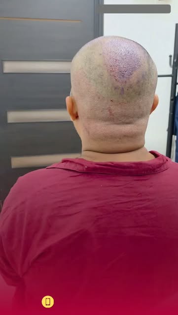 Doctor-Performed FUE Hair Transplant — From Planning to Precision Execution
In our previous post, we