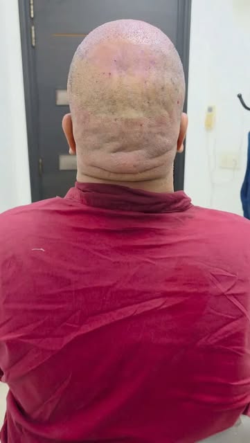 ⚠️ WHO SHOULD PERFORM YOUR FUE HAIR TRANSPLANT?

A hair transplant is not merely about creating a ne