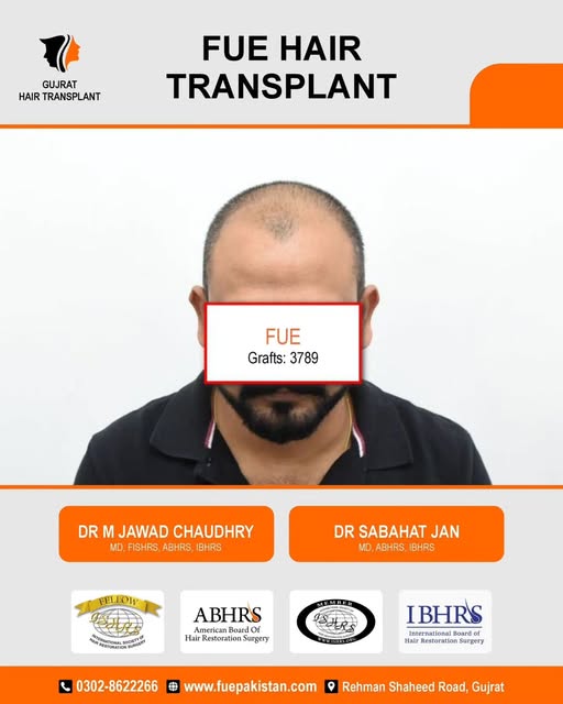 ✨ HOW TO GET THE MOST NATURAL & UNDETECTABLE HAIR TRANSPLANT?

A successful hair transplant should n