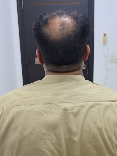 🔥 6800 GRAFTS — FUT MEGA SESSION HAIR TRANSPLANT 🔥

Not all Hair Transplants are the same. Choose 