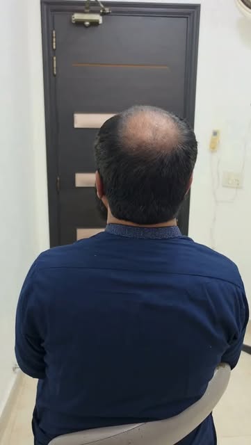 🧑‍⚕️ CAN THIS TYPE OF BALDNESS BE TREATED IN A SINGLE HAIR TRANSPLANT MEGA SESSION?
Yes — in carefu