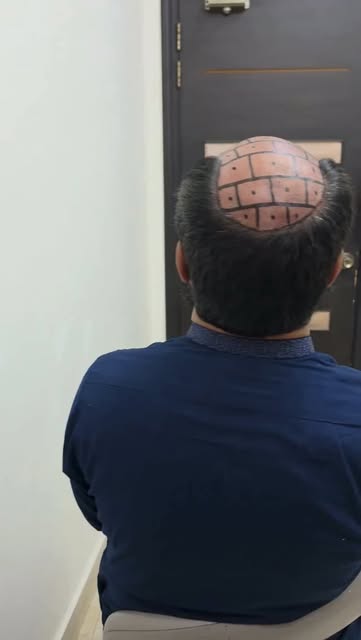 ✨ EVERY SUCCESSFUL HAIR TRANSPLANT STARTS WITH PROPER PLANNING ✨
A Hair Transplant Mega Session is n