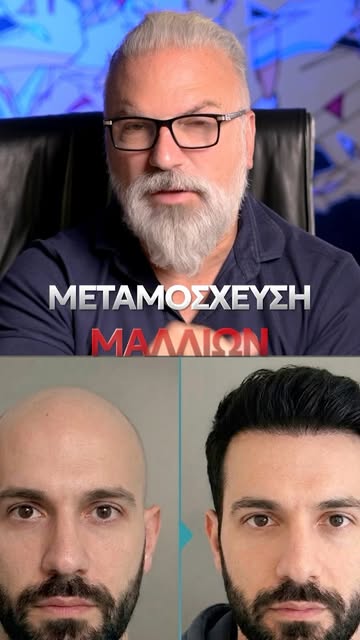 Εδώ βλέπουμε έναν άντρα που είχε χάσει σχεδόν όλα του τα μαλλιά και σήμερα έχει ένα πραγματικά πλούσ