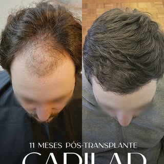 Resultado 11 meses após transplante capilar. 🧔🏻‍♂️

Neste caso, o paciente apresentava queda acent