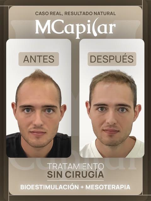 Desliza para ver 𝘂𝗻 𝗰𝗮𝗺𝗯𝗶𝗼 𝗿𝗲𝗮𝗹.

Enrique ha logrado mejorar muchísimo la calidad y dens