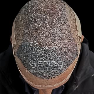 Cerramos otra semana de procedimientos con éxito en Spiro Hair. Cada caso es único y nuestro objetiv