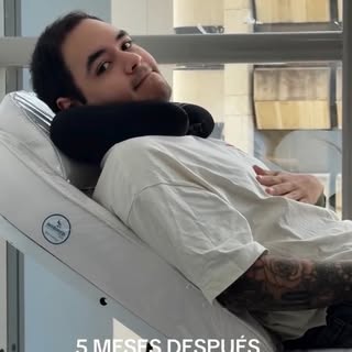 5 meses después… así vamos.
Mi esposo se hizo un trasplante capilar en @spirohairrestoration con la 