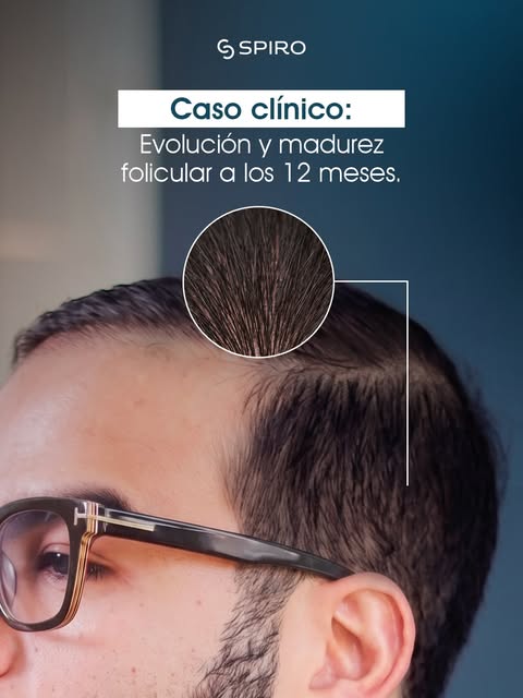 Un buen injerto no es solo poner pelo donde falta; es cuidar cómo sale y mantener la densidad de la 