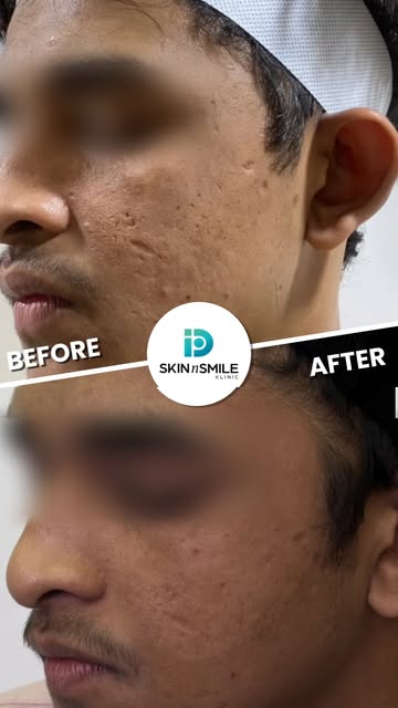 ✨ Texture transformed, confidence restored! ✨

Acne scars can feel permanent, but the right technolo