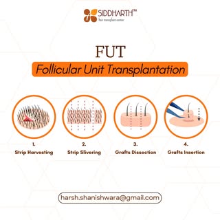 FUT (Follicular Unit Transplantation) restores hair by taking a strip, preparing follicles, and plac