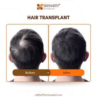 Say goodbye to hair loss and hello to confidence! 🌟 Transform your look with Siddharth Hair Transpl