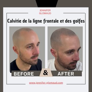 Après 2 séances de Tricopigmentation effet rasé.
Nous réalisons une 3ème séance pour parfaire le rés