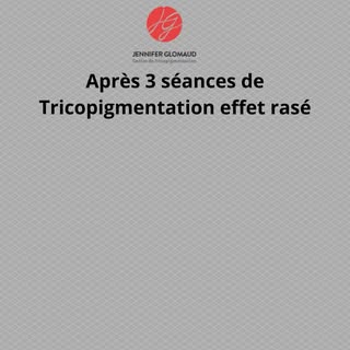 Après 3 séances de Tricopigmentation effet rasé.#jenniferglomaud #greffe
#tatouagecheveuxhomme #tric