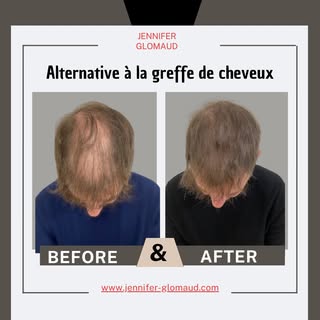 Après 3 séances de Tricopigmentation effet de densité
Pas d'éviction sociale
Inutile de vous raser l