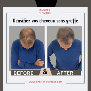 Après 3 séances de Tricopigmentation effet densité.
Inutile de se raser la tête.
Résultats en 2 mois