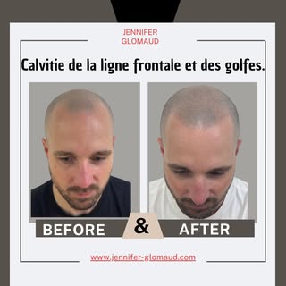Après 2 séances de Tricopigmentation effet rasé.
Nous réalisons une 3ème séance pour parfaire le rés