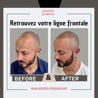 Après 3 séances de Tricopigmentation effet rasé
L'harmonie du visage est retrouvé

#jenniferglomaud 