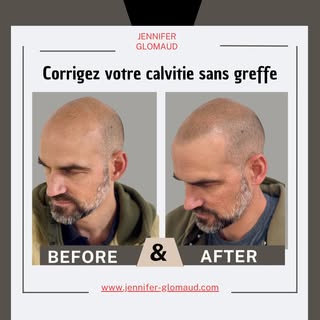 Corrigez votre calvitie sans greffe . Après 3 séances de Tricopigmentation effet rasé
Résultats en 1
