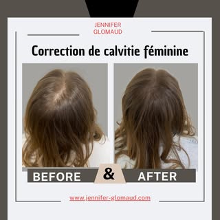 #Après 3 séances de Tricopigmentation effet de densité.
Sans éviction sociale.
Sans traitement pré o