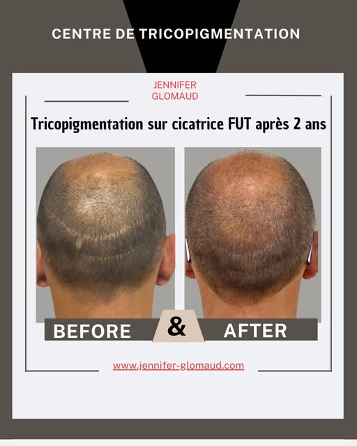 2 ans après Tricopigmentation sur cicatrice FUT…

#jenniferglomaud #greffe
#tatouagecheveuxhomme #tr