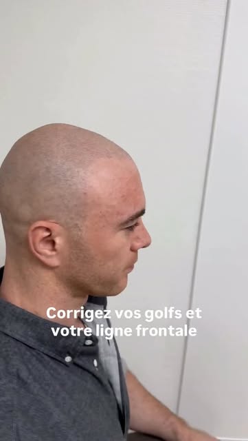 Après 3 séances de Tricopigmentation effet rasé
Sans éviction sociale
Résultats en 1 mois 