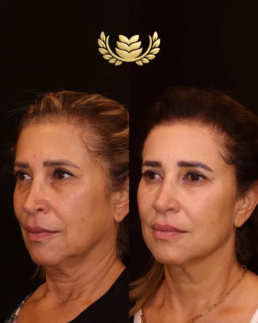 ✨ סוג הטיפול: שיטת שלוש השכבות®™ להרמה, מיצוק ושיפור איכות העור. תוצאות טבעיות שנשמרות לאורך זמן.
💉