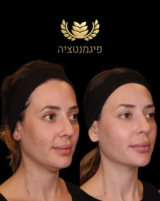 סוג הטיפול: פיגמנטציה, כתמי גיל ושיפור איכות העור
💉 שיטת הטיפול: טיפול מתקדם המשלב אבחון מדויק והתא