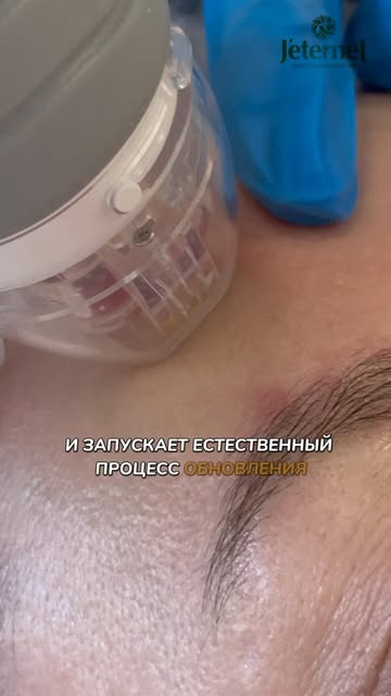 🔥 26 сентября в Jeternel — специальный день микроигольчатого RF-лифтинга! Количество мест ограничен