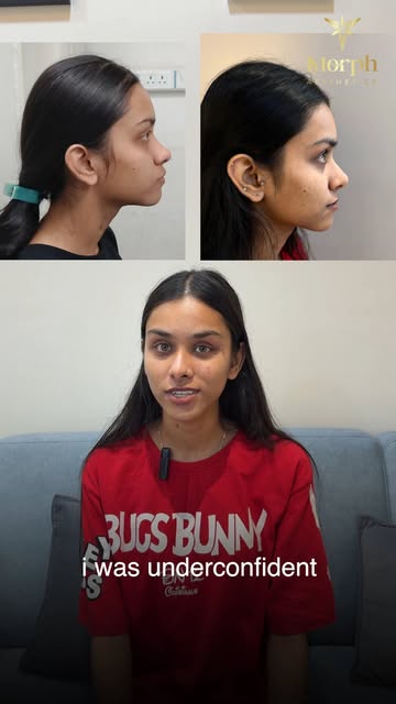 A journey from self-doubt to renewed confidence. ✨❤️

Sneha shares her rhinoplasty journey at Morph 