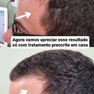 Essa é a vantagem de começar a tratar calvicie no começo!

Apenas com tratamento prescrito para casa