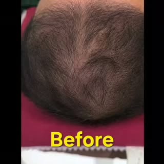 Patient has done few sessions of gfc and have taken 6 session of gfc programme