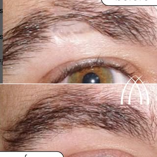 Friday: Gaviria’s Results! This patient came to us after an accident left a visible scar on the eyeb