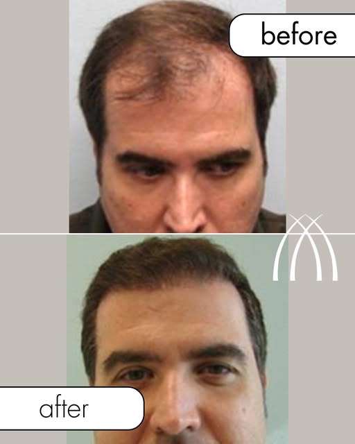 Gaviria Results.

This is why we always talk about natural results.

The goal is not to give you a “