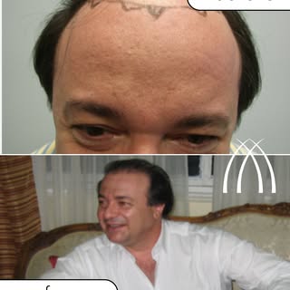 This result didn’t happen overnight. And that’s the point.

Hair restoration is a process. Your hair