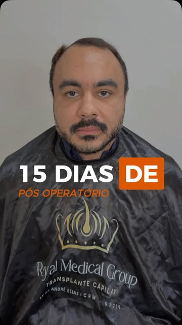 Cada fase do transplante capilar tem sua importância, e o acompanhamento adequado é fundamental para