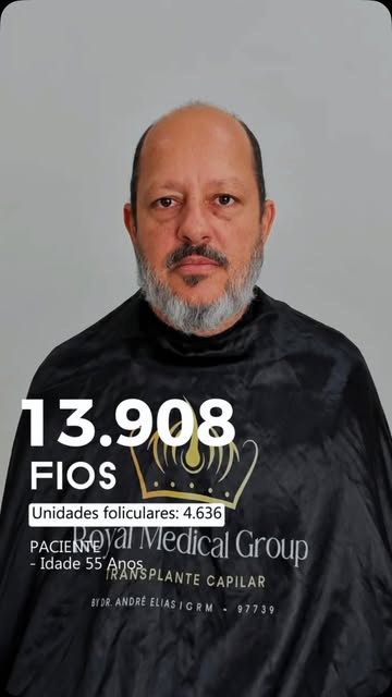 Aos 55 anos, nosso paciente deu um passo importante para recuperar não apenas os fios, mas também a 