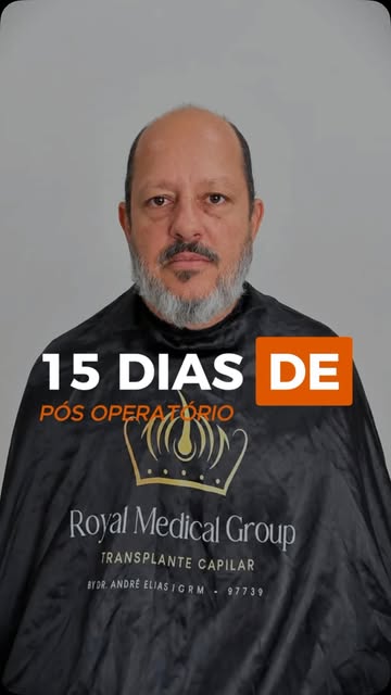 15 dias de pós-operatório de transplante capilar!

Com apenas 15 dias, o paciente relata que não sen