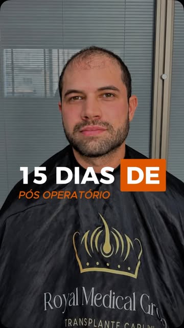 Com apenas 15 dias, a área doadora já está cicatrizada e a recuperação segue de forma tranquila. Um 