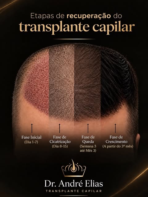 Após o procedimento, é esperado que o couro cabeludo passe por diferentes fases: cicatrização, queda