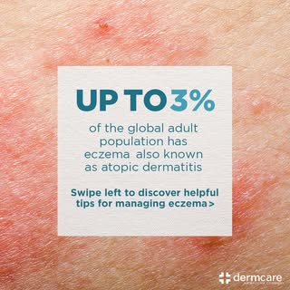 Suffering from eczema? 😢

⬅️ Swipe left to discover helpful tips for managing atopic dermatitis.

�