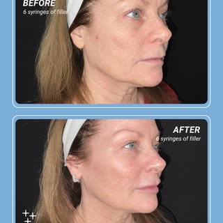 ✨ Facial Contouring with 6 syringes of filler & full face neuromodulators ✨

One of my favorite trea