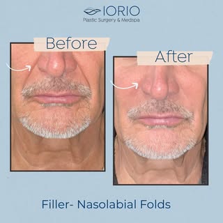 Ever wonder what filler can do for smile lines?

Nasolabial fold filler helps restore volume beneath