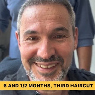 Hey everyone! It’s been 6 and a half months since my hair transplant procedure, and today was my thi
