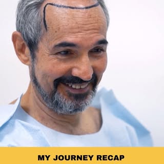 My Journey Recap 🙌🏻

Can you believe it’s been over 7 months since my hair transplant?! Stay tuned