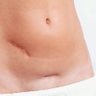 🔊¿Tienes una cicatriz de cesárea que te preocupa? ¡La medicina estética puede ayudarte con ello! 💁